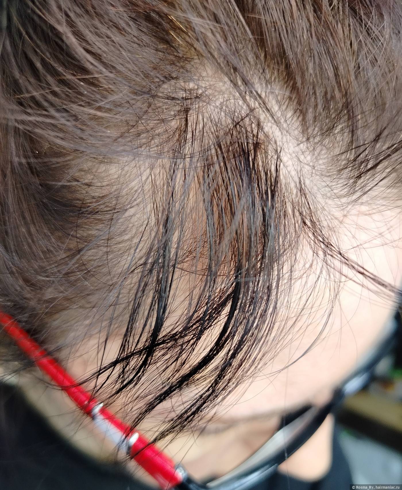 Фото: Зарастающие залысины на висках, фото 1