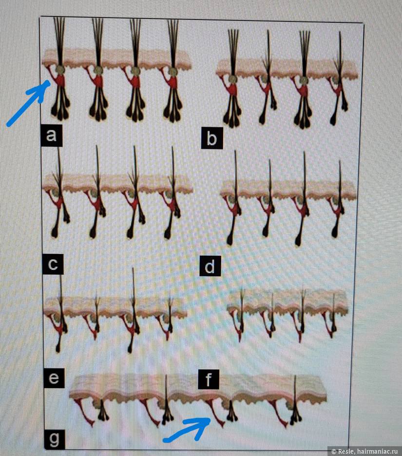 Фото: Стадии миниатюризации фолликула и мурашечного мускула