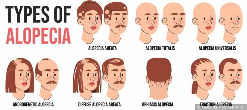 Фото: Виды алопеции