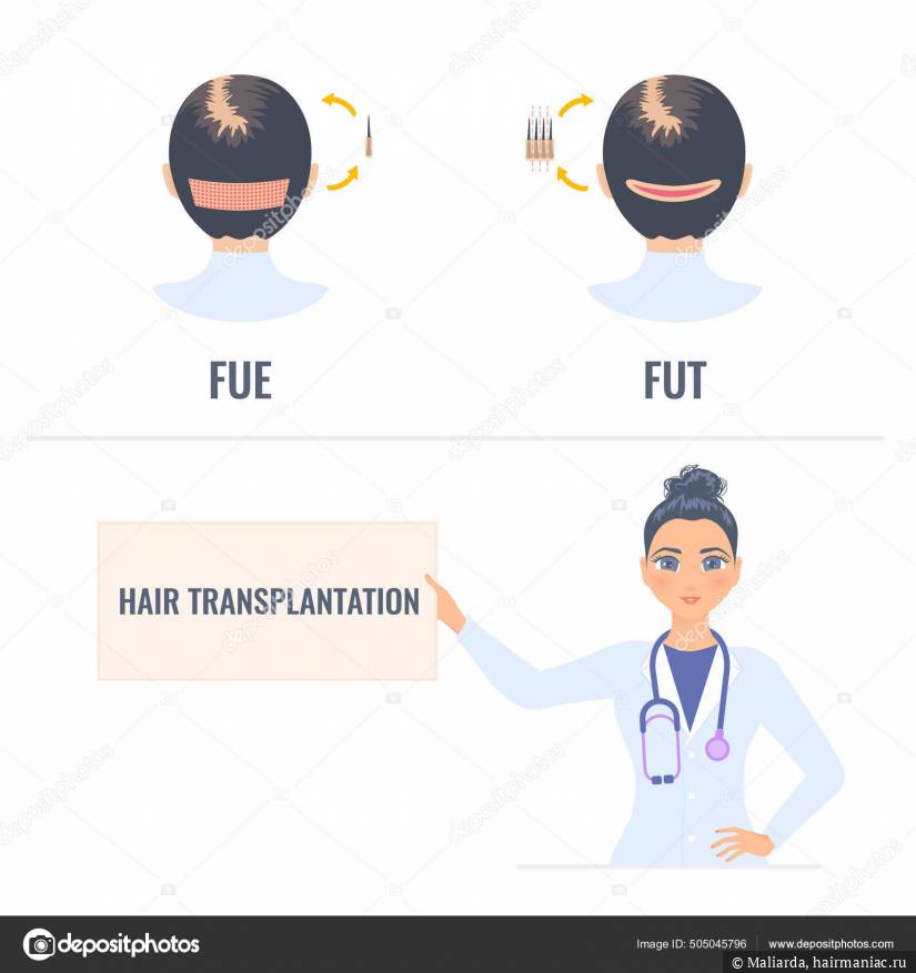 Фото: FUE и FUT