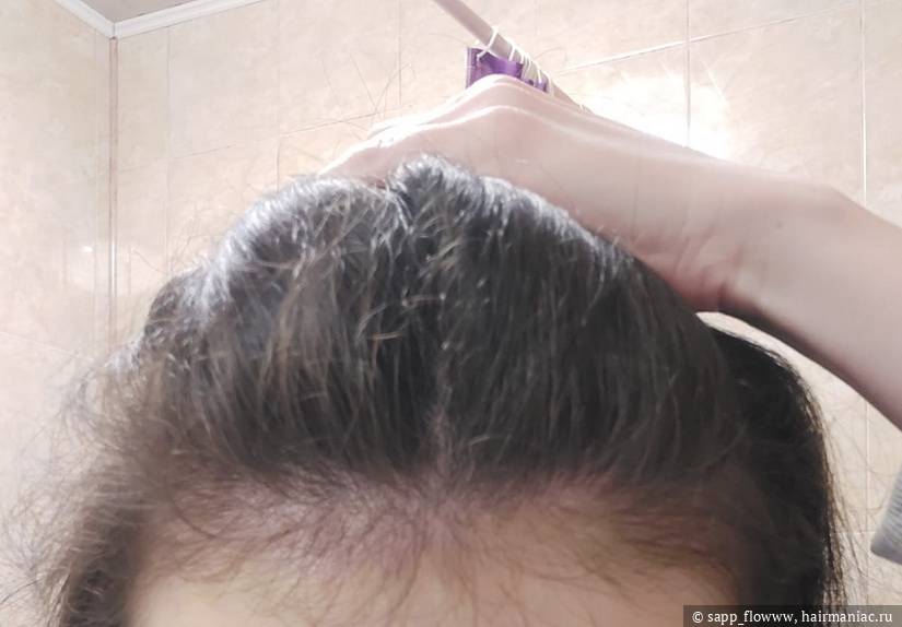 Фото: Проредевшая лобная зона