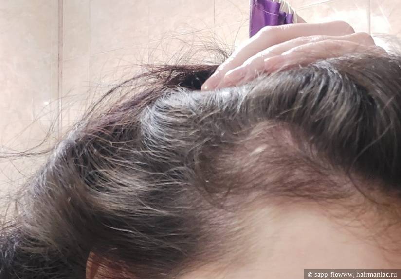 Фото: Проредевшая правая височная зона