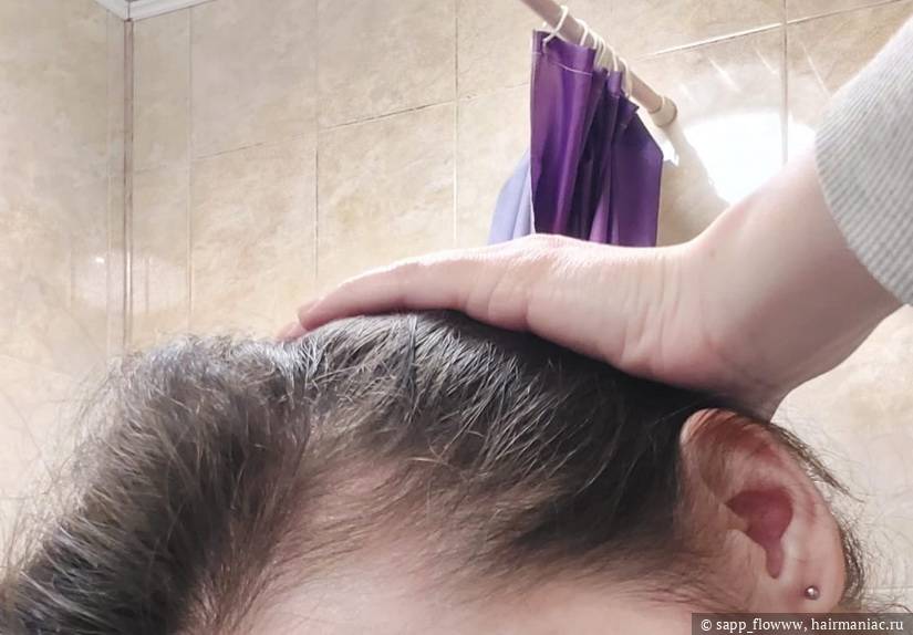 Фото: Проредевшая левая височная зона