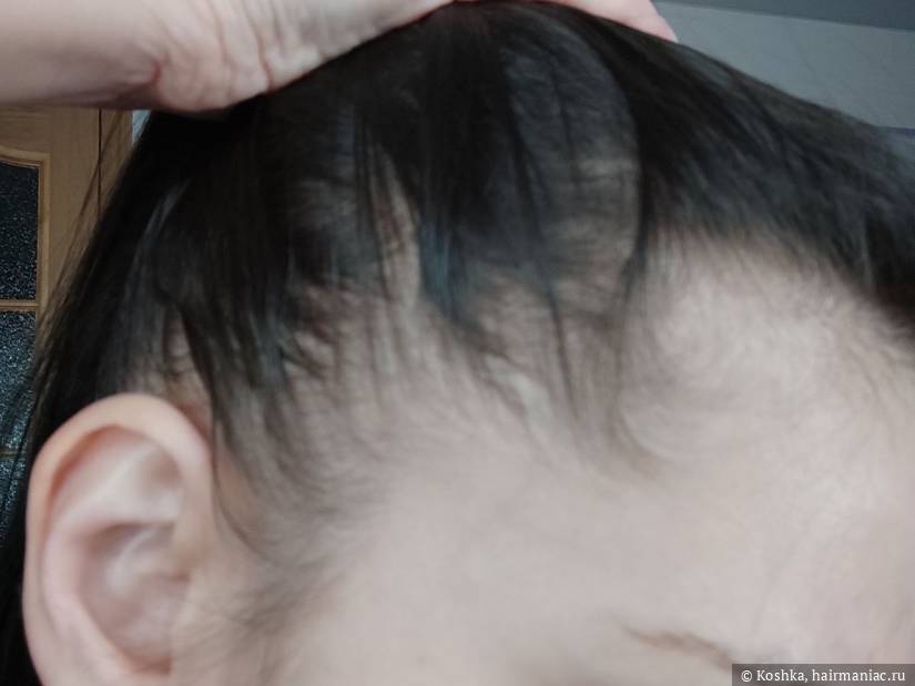 Фото: Густота на висках