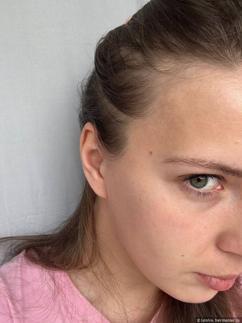 Фото: правый висок ноябрь